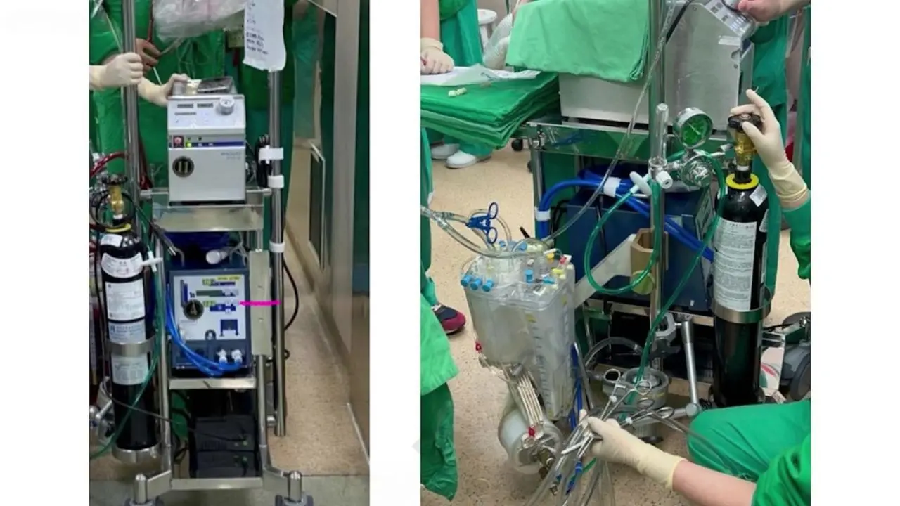 World’s first continuous beating heart transplant