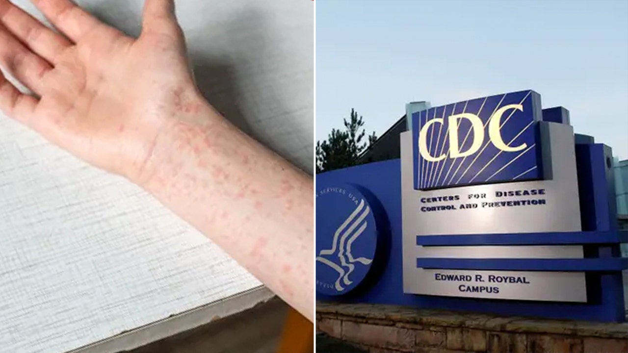 Texas’ measles outbreak explodes to 561 cases