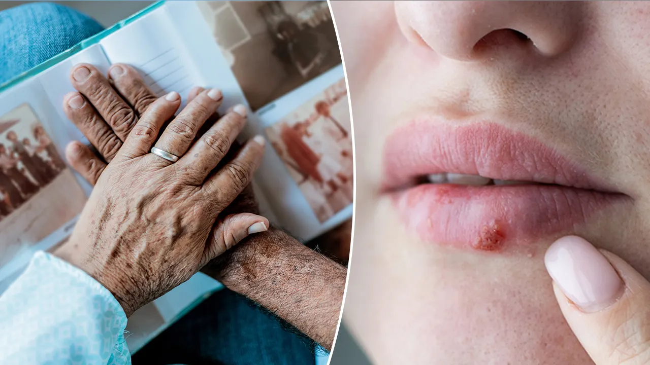 Alzheimer’s disease risk linked to cold sores, similar viruses in new study