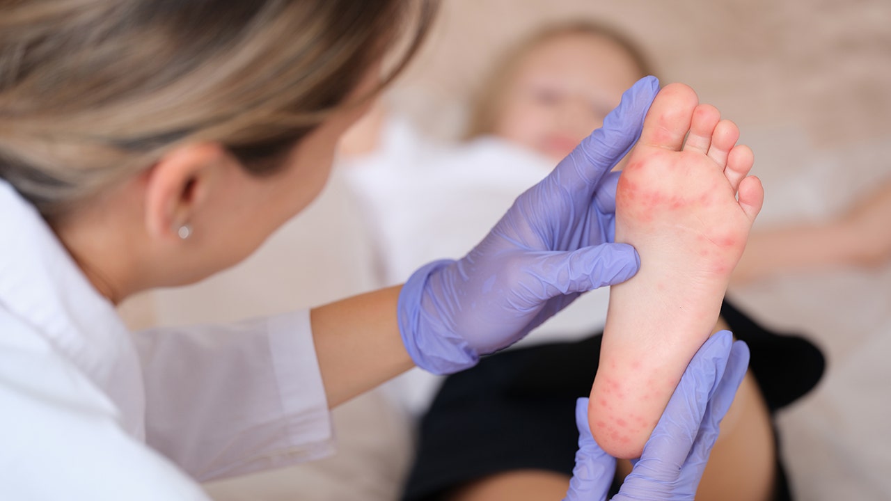 Hand, foot and mouth disease cases rising across multiple parts of US