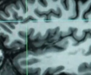 Huntington’s disease treated for first time