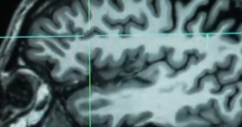 Huntington’s disease treated for first time