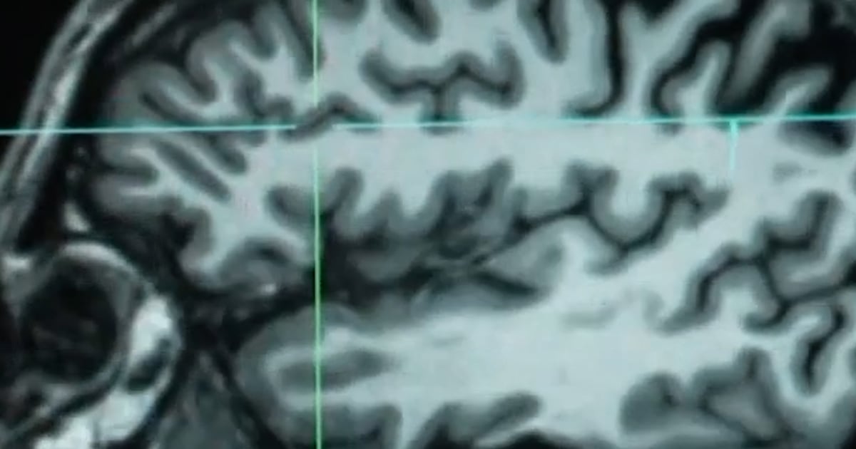 Huntington’s disease treated for first time