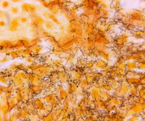 Why Syphilis Cases in Newborns Are Rising