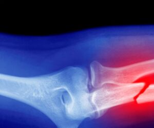 Microplastics Could Be Weakening Your Bones, Research Suggests