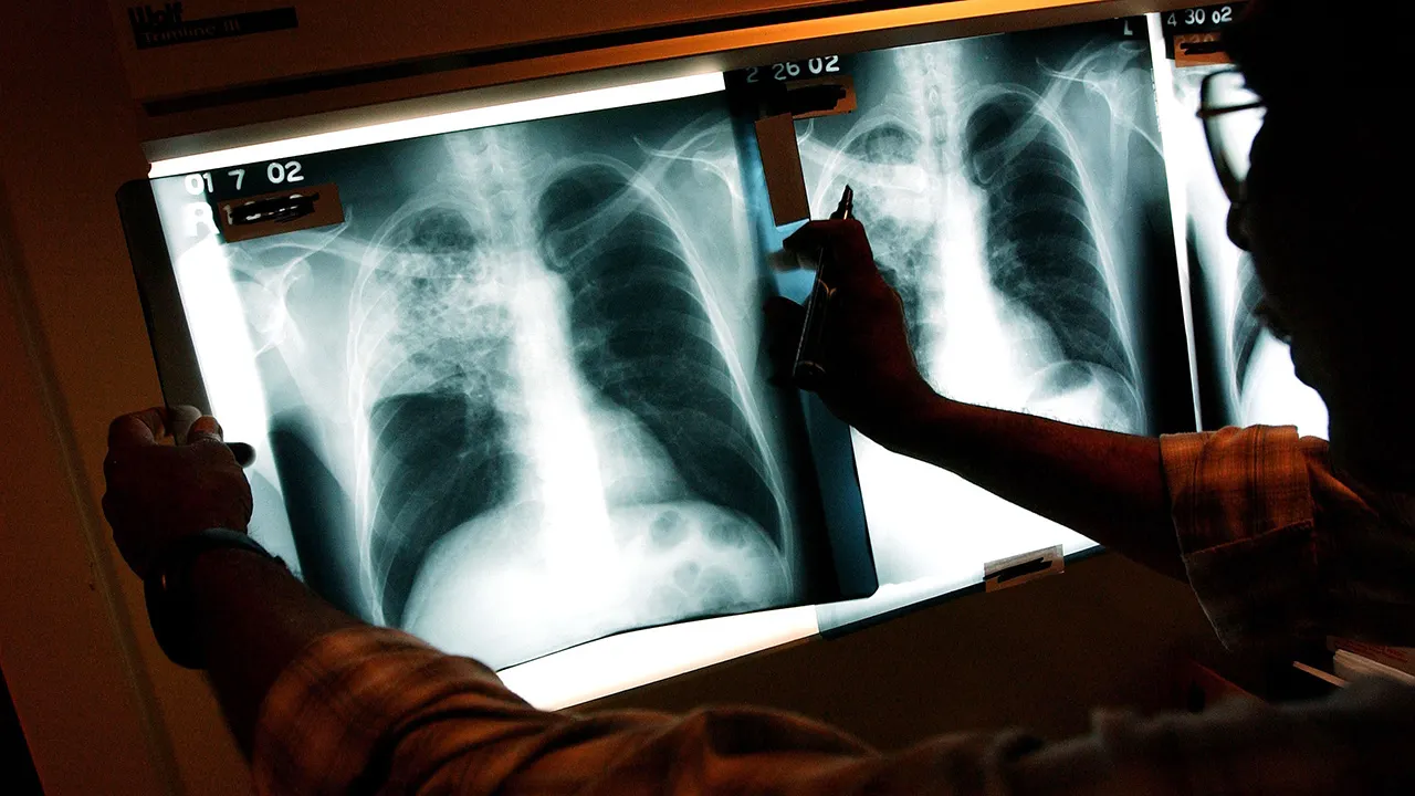 Maine reports 3 active TB cases, world’s deadliest infectious disease