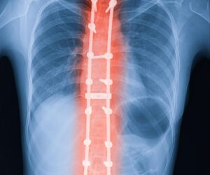 New Groundbreaking Scoliosis Study 8 Years In The Making: What To Know