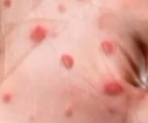 Hundreds of students quarantine amid measles outbreaks
