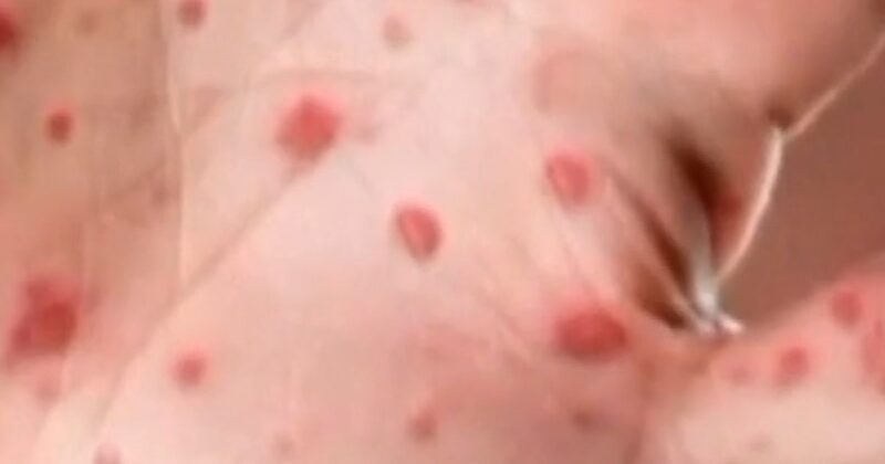 Hundreds of students quarantine amid measles outbreaks