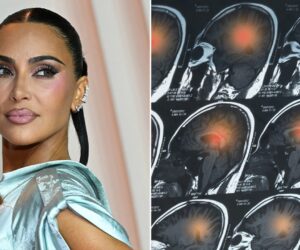 Doctors sound alarm after Kim Kardashian’s brain aneurysm revelation