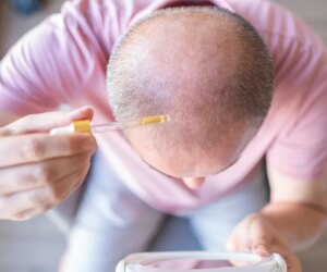 New baldness therapy could regrow hair in 20 days using serum treatment