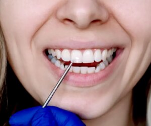Scientists use human hair proteins to repair damaged tooth enamel